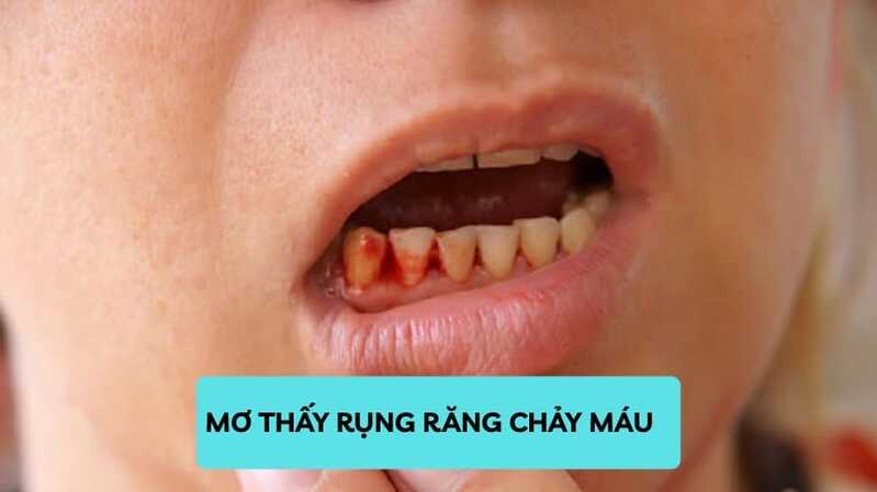 Mơ thấy rụng răng có máu thường gắn với cảm xúc mạnh, lo lắng hoặc áp lực về sức khỏe và quan hệ. 